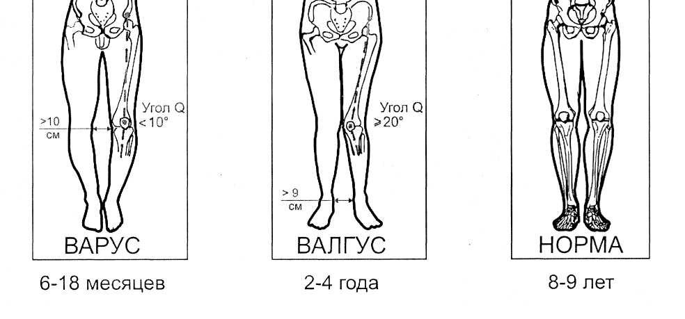 Ноги ребенка по возрасту. Форма ног.