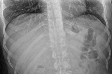 лечение позвоночника